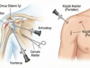 Kapalı Omuz Ameliyatı ile Etkili Tedavi