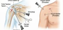 Kapalı Omuz Ameliyatı ile Etkili Tedavi