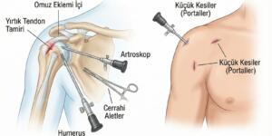 Kapalı Omuz Ameliyatı ile Etkili Tedavi